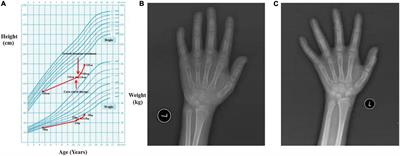 Case Report: Glycogen Storage Disease Type Ia in a Chinese Child Treated With Growth Hormone